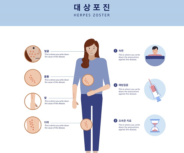 대상포진 초기 증상, 젊은 사람도 걸리는 이유와 골든타임 72시간