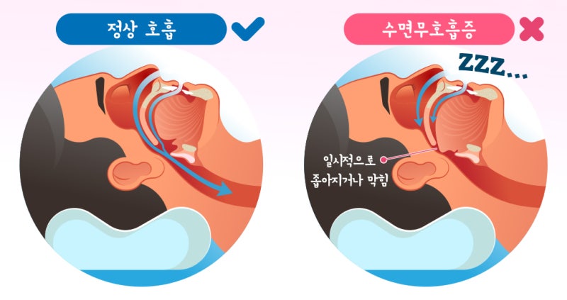 수면무호흡증 증상 7가지, 코골이가 단순 코골이가 아닌 경우